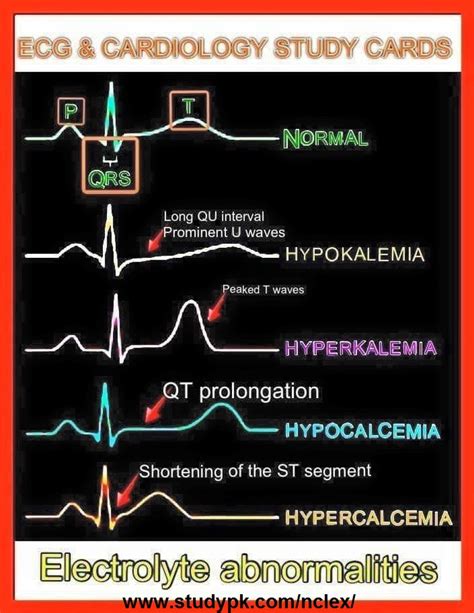 ECG Cardiology Study Cards Electrolyte Abnormalities StudyPK