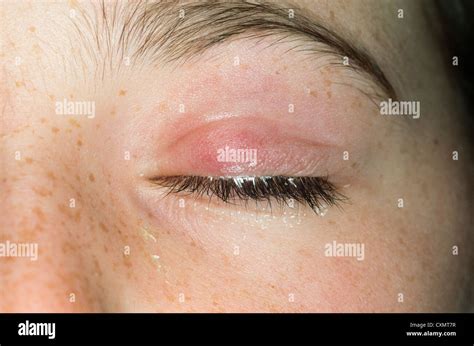 Swelling Of The Eyelid Hi Res Stock Photography And Images Alamy