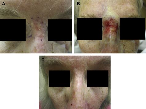 Surgical And Noninvasive Modalities For Scar Revision Dermatologic