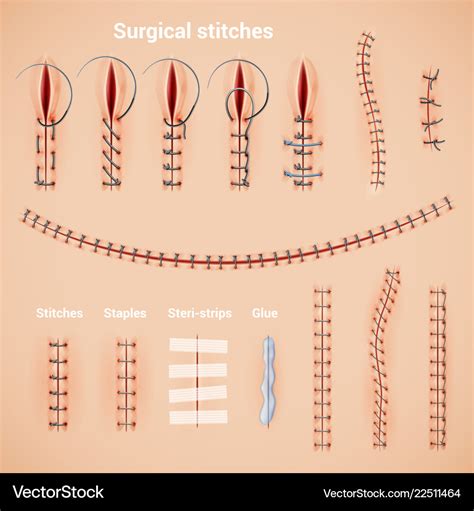 Surgical Stitches Infographic Set Royalty Free Vector Image