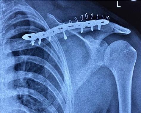 Figure 8 Clavicle Fracture