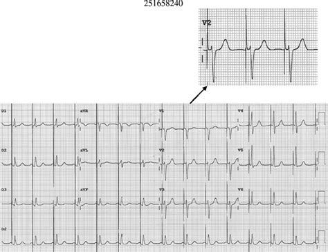 Twelve Lead Surface Ecg Showing Selective His Bundle Pacing Download