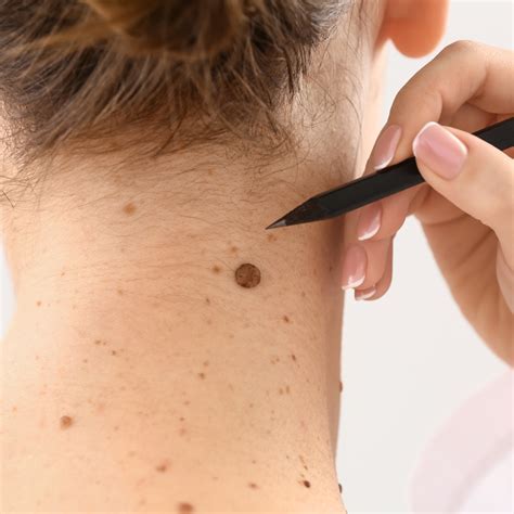 Can I Remove A Mole On My Neck Learn About Neck Mole Removal