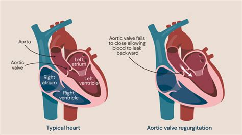 Aortic Regurgitation Causes Symptoms And Treatments