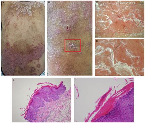 Dermoscopic Features Of Acutely Exacerbated Plaque Psoriasis Induced By