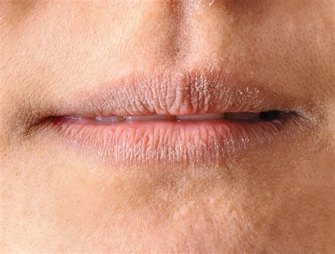 Lip Lickers Eczema Dermatitis — Medical Secrets