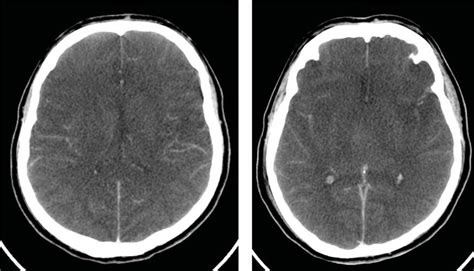 Ct Brain Showing Subarachnoid Hemorrhage Like Appearance Download