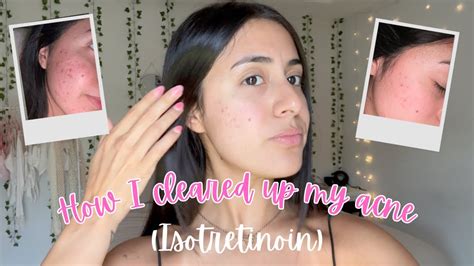 My Acne Progress How I Cleared My Acne ♡ Youtube