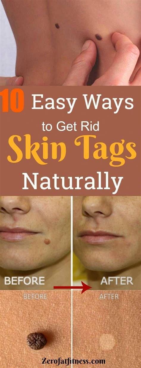 How To Get Rid Of Skin Tags Fast In 10 Easy Natural Painless Ways Find