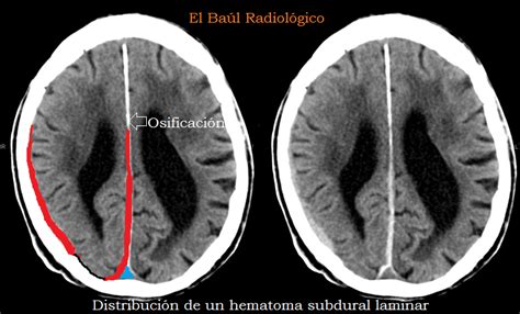 El Ba L Radiol Gico Hematoma Subdural Laminar Detecci N Mediante Tomograf A Computarizada