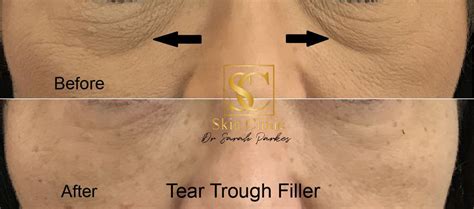 An ice pack or warm compression can help to heal a black eye a little quicker. Tear Trough filler injections - Skin Clinic