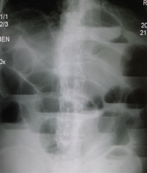 Fileupright X Ray Demonstrating Small Bowel Obstruction