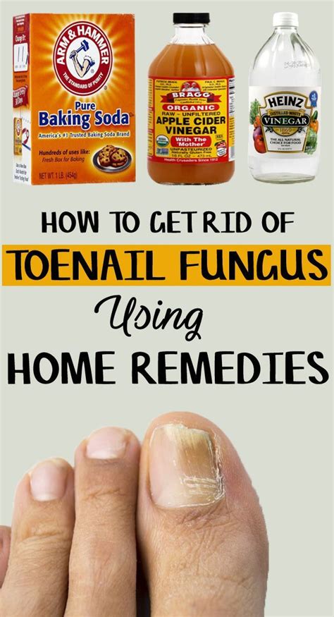 How To Get Rid Of Toenail Fungus 9 Home Remedies Included Toenail Fungus Home Remedies