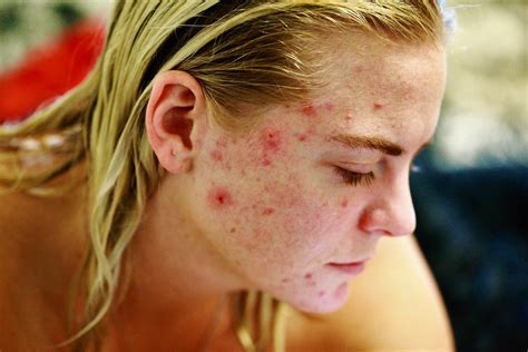 thirteen ways to remove acne scars quickly in one day healthkhu