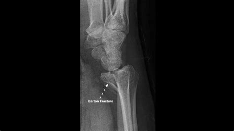 Wrist X Ray Interpretation Osce Guide Geeky Medics