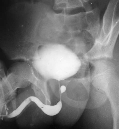 Midline Prostatic Cyst In A Young Man With Lower Urinary Tract Symptoms Bmj Case Reports