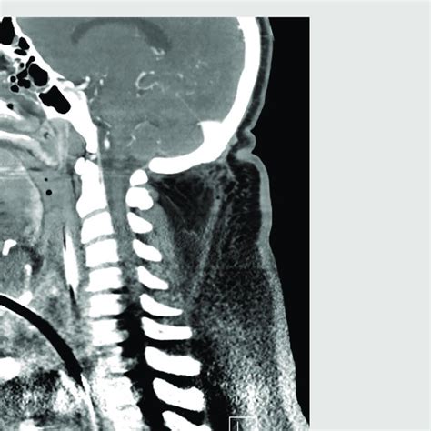 Computed Tomography Scan Ct Scan Of The Head And Neck With A Surgical