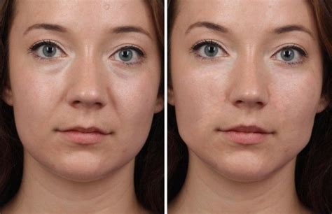 Plastic Surgery Bags Under Eyes › Under Eye Plastic Surgery For