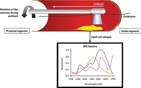Near Infrared Spectroscopy Nirs A Novel Tool For Intravascular