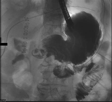 Endoscopic Pyloric Exclusion—eus Guided Gastrojejunostomy Combined With