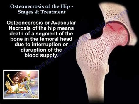 Osteonecrosis Hip Joint