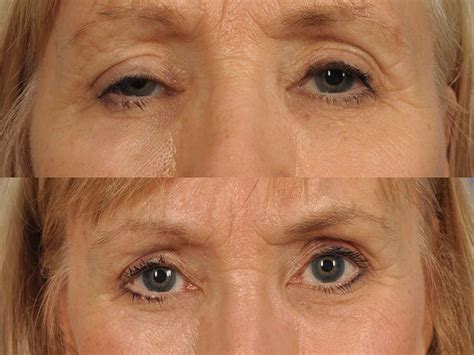 Ptosis Or Drooping Eyelid Symptoms Causes Diagnosis And Treatment