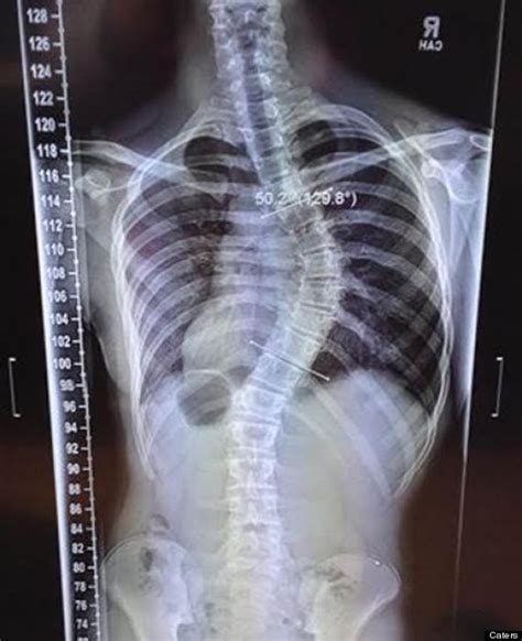 Teen Gymnast With Spine Bending Condition Scoliosis Makes ...