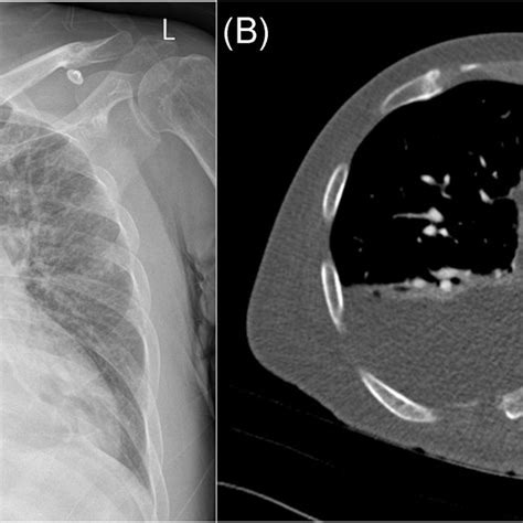 Chest X‐ray Showed Cardiomegaly Bilateral Pulmonary Congestion