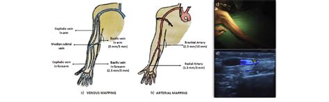 If you've ever seen a road map, you probably saw many roads going here, there, and everywhere. (a, b) Minimum diameter/maximal depth of brachial artery and basilic... | Download Scientific ...