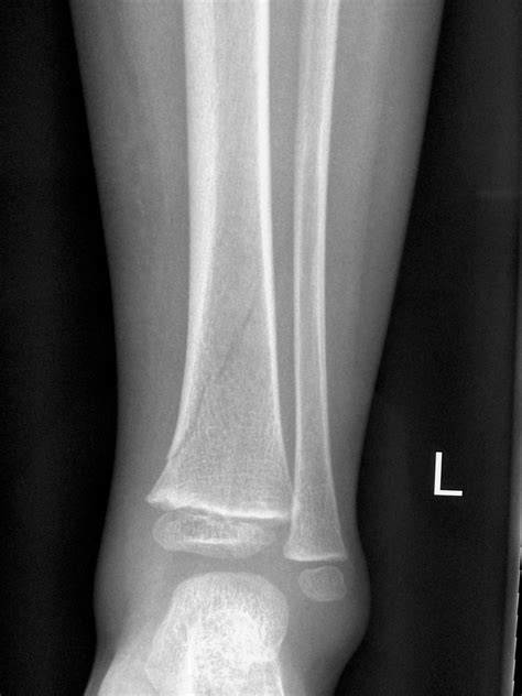 Spiral Fracture Tibia Child Treatment Clinical Case 111 Toddlers