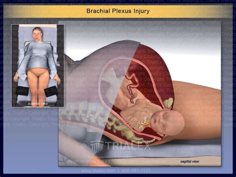 Posterior Brachial Plexus During Delivery Trial Exhibits Inc