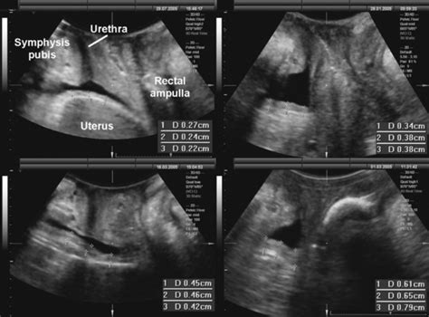 [34 ] Uterine Prolapse Ultrasound Radiopaedia