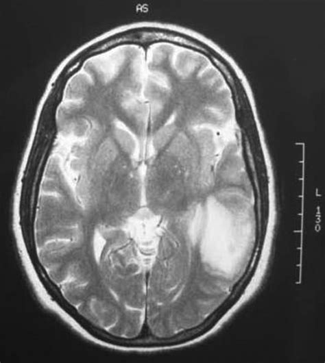 Mri Of The Brain Hemorrhagic Infarction Of The Left Temporal Lobe