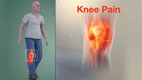 Knee Pain Caused By Damage In Knee Joint Shown Using Medical Animation