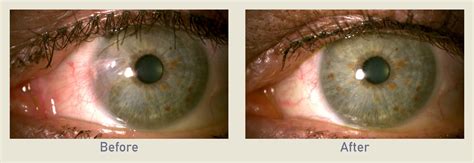 Pterygium Removal Before After Photo Gallery Los Angeles