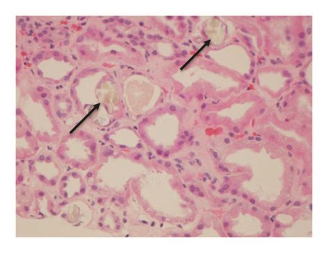 A Renal Biopsy Light Microscopy Stain Hematoxylin And Eosin