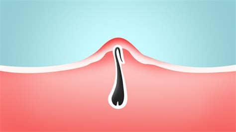 Download armpit hair stock photos. How to Get Rid of Ingrown Hairs