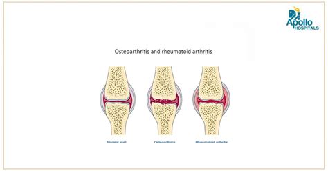 What Are The Different Causes For Rheumatoid Arthritis Apollo
