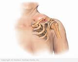 Distal Clavicle Fracture Treatment Pictures
