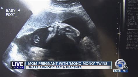 orrville mom delivers rare set of mono mono identical twin girls youtube