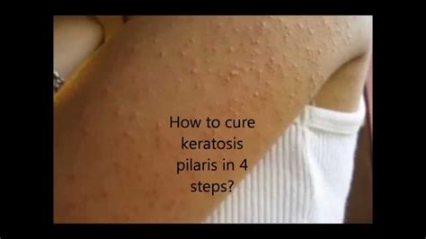 Before And After Keratosis Pilaris