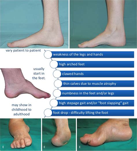 Charcot Marie Tooth Disease The Perfect Conversions