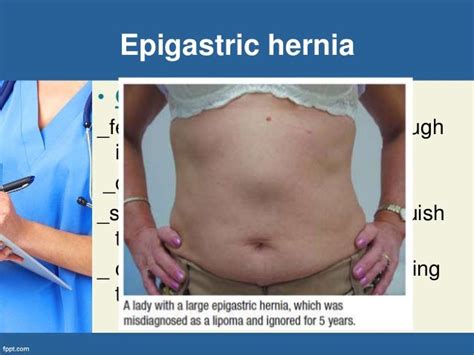 Abdominal Hernia Pictures