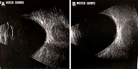 Ocular Ultrasound Of The Left Eye A B Ocular Ultrasound Showed That