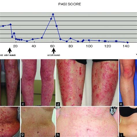 Pdf Treatment Of Active Acne Vulgaris By Chemical Peeling Using Tca 35