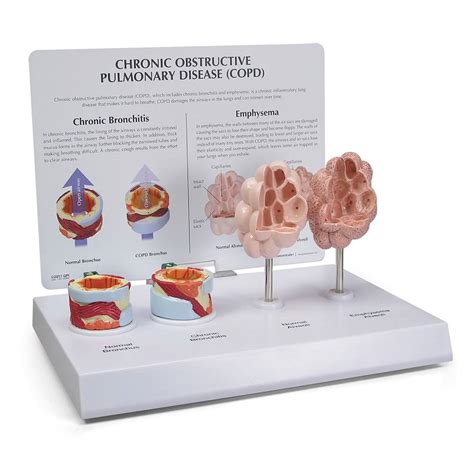 Gpi Anatomicals 3130 Copd Model With Bronchus And Alveoli