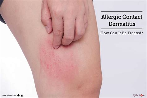 Allergic Contact Dermatitis How Can It Be Treated By Dr Amit