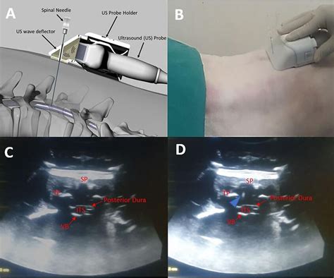 Development Of A Real Time Ultrasound Guided Lumbar Puncture Device
