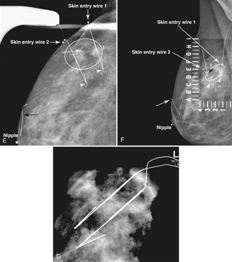 Mammographic And Ultrasound Guided Breast Biopsy Procedures Radiology Key