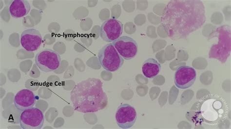 Chronic Lymphocytic Leukemia Cll With Presence Of Pro Lymphocytes 6